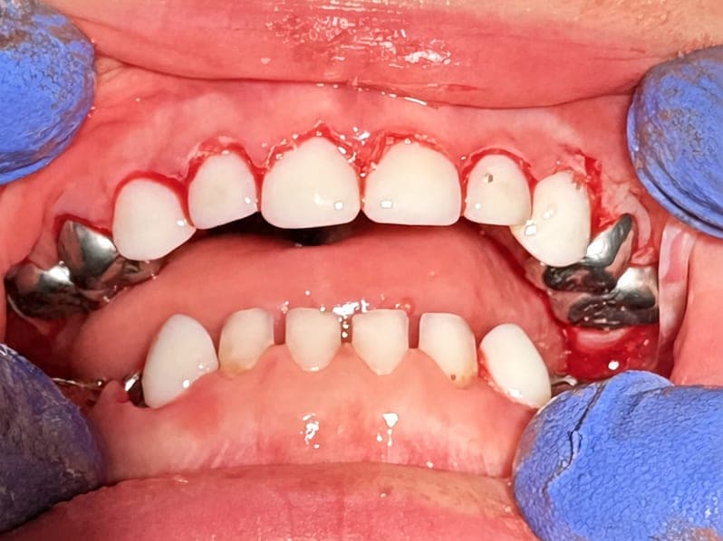 Immediate post-operative view of zirconia upper incisor crowns and stainless steel molar crowns