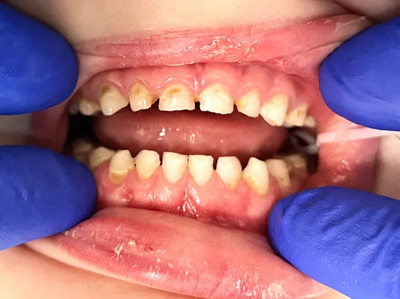 Pre-operative retracted view of both primary arches with generalized caries