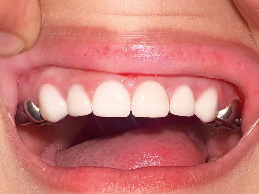 Post-operative view of zirconia upper incisor crowns alongside stainless steel molar crowns