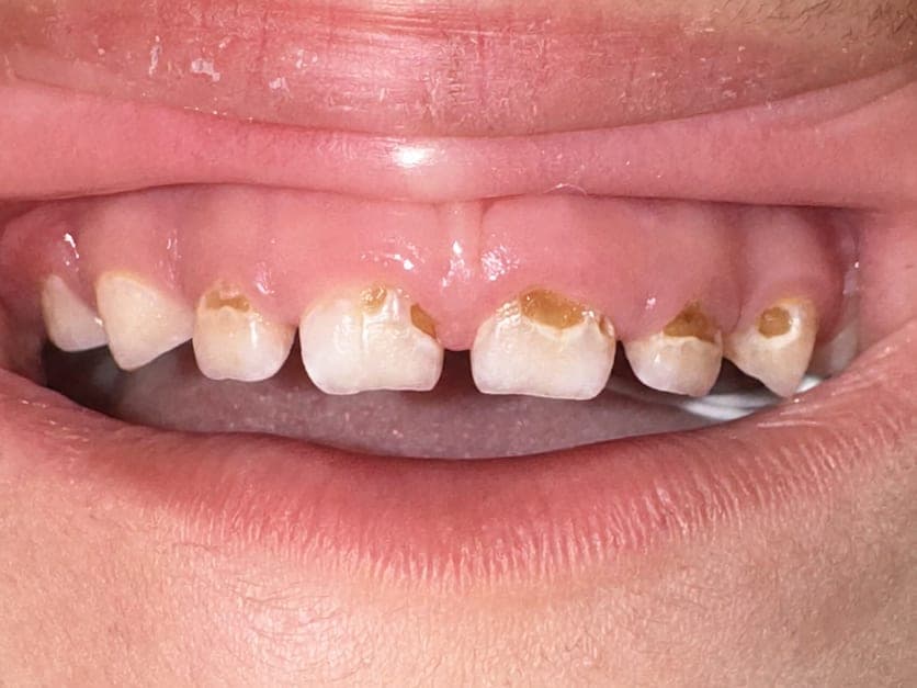 Pre-operative smile view of maxillary primary incisors with cervical caries