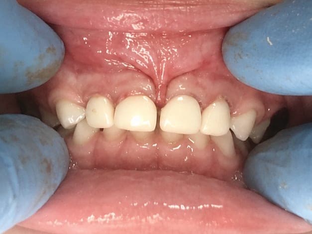 Post-operative view of four zirconia upper incisor crowns