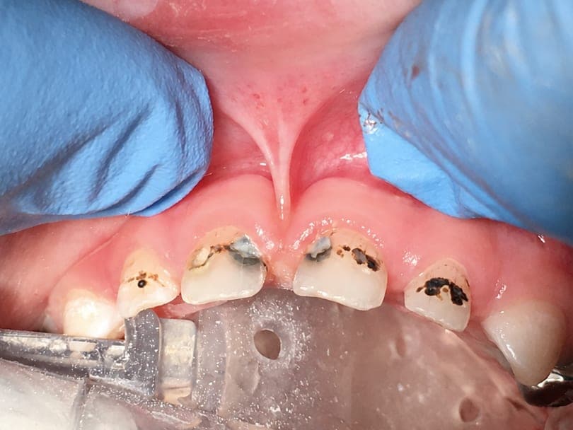 Pre-operative isolated view of four maxillary primary incisors with dark interproximal and facial caries