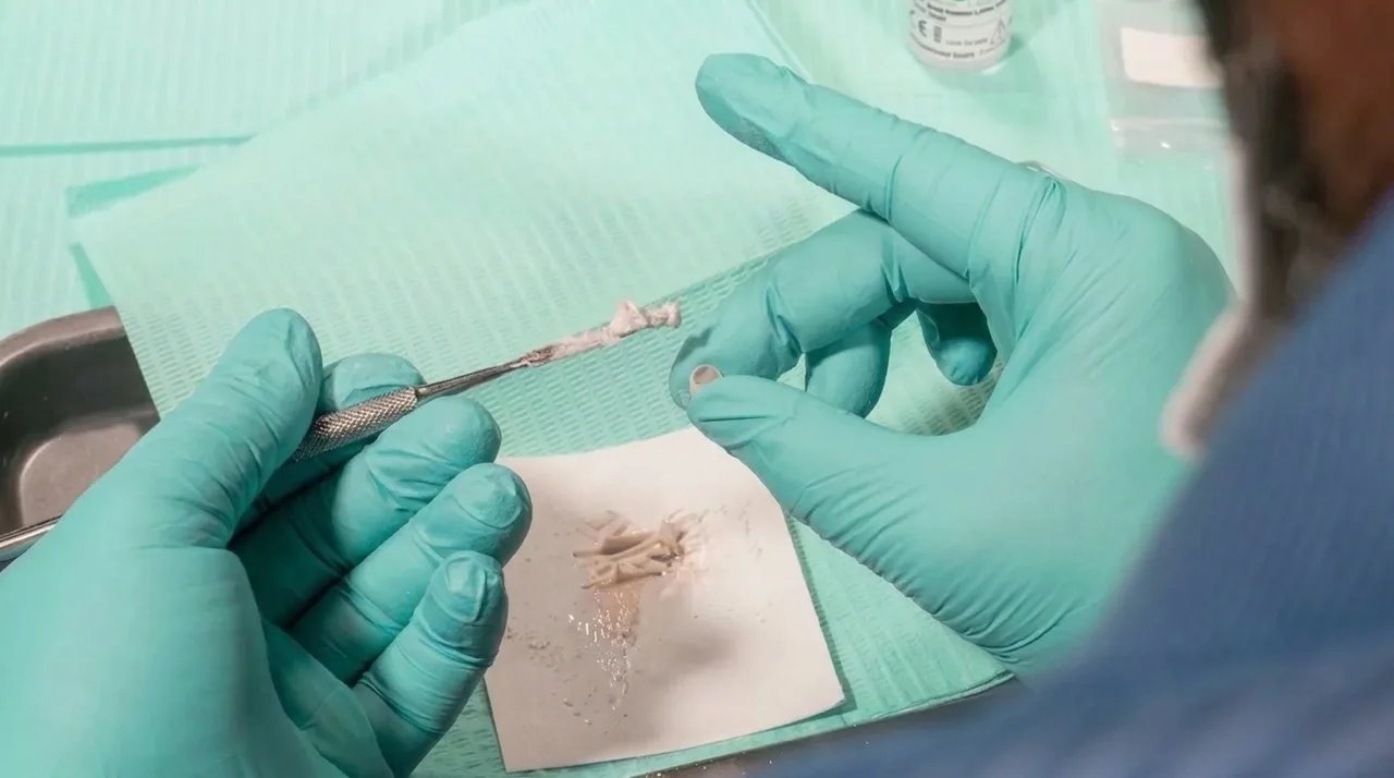 Glass ionomer cement mixed to a thick, putty-like consistency for a pediatric zirconia crown